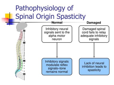 Ppt Intrathecal Baclofen For Spasticity Powerpoint Presentation Free Download Id 1245439