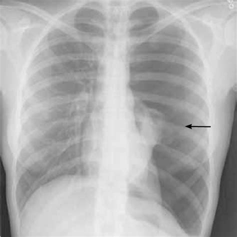 Left Sided Pneumothorax Arrow On Chest Radiography At Presentation