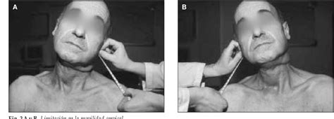 Figure From Fisioterapia Y Reeducaci N De La Degluci N En La Cirug A