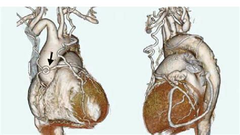 Postoperative 3d Ct Image Left The Svg Graft Had A Severe Stenosis Download Scientific