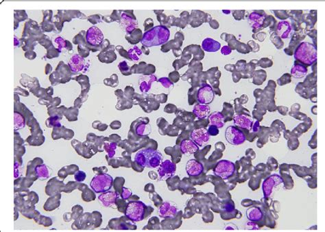 Bone Marrow Specimen Showing Increased Plasma Cells And Eosinophils