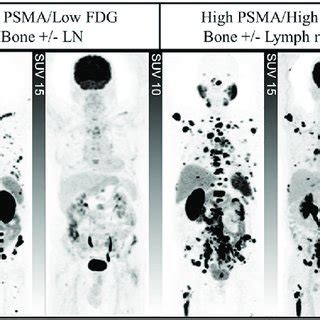 Re Treatment With 177 Lu PSMA RNT Pretreatment PSMA PET CT Images A