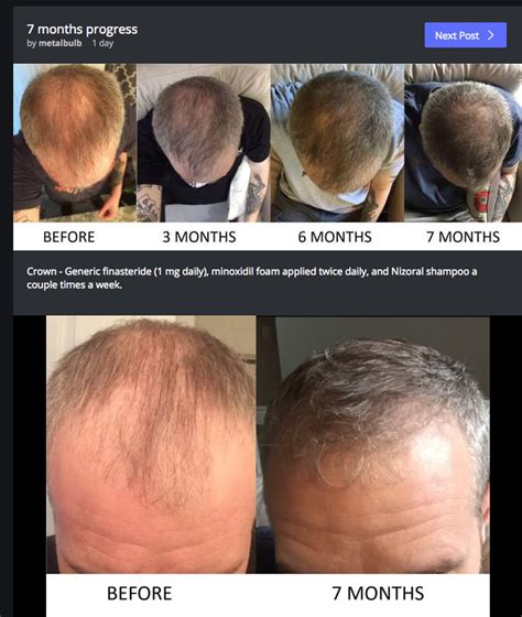 51 Year Old Male Went On Finasteride And Minoxidil Twice A Day For 7