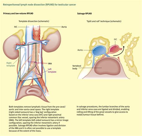 Management Of Testicular Tumours Surgery Oxford International Edition