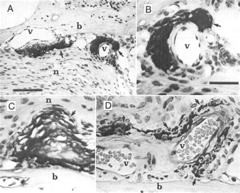 Figure 3 from Otic Capsule Bony Lesions in the Palmerston North ...