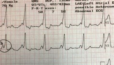 Wolff Parkinson White Syndrome Consultant360