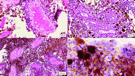 | A 71-year-old female patient's brain metastatic melanoma is comprised... | Download Scientific ...