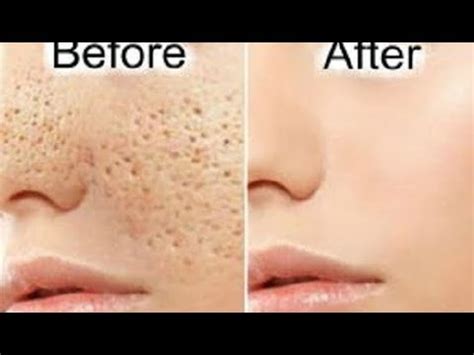 Apply It Night Skin Repair Overnight How To Get Rid Of Large Open