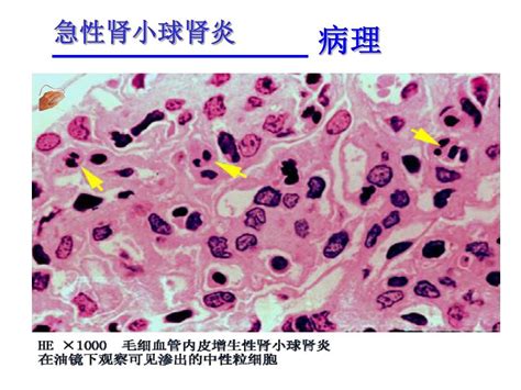 小儿急性肾小球肾炎word文档在线阅读与下载无忧文档