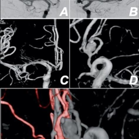 Carotid Angiography To Detect Aneurysm In The Anterior Communicating