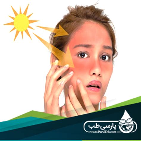 How to treat sunburn? (Part II) - Parsi Teb