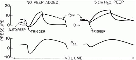 Positive End-Expiratory and Continuous Positive Airway Pressure | Anesthesia Key