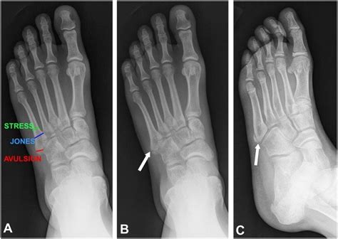 Metatarsal Head Fracture