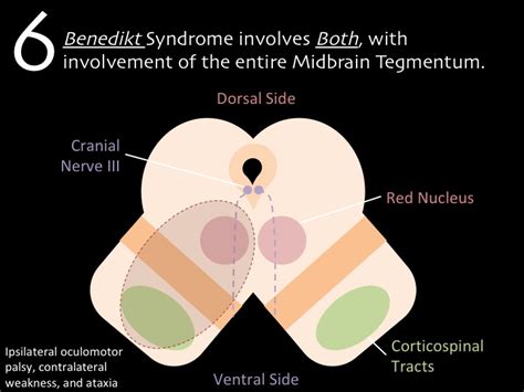 Benedikt Syndrome