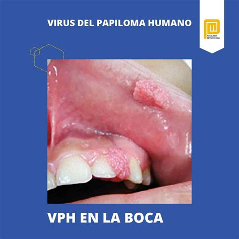 Sintomas De Vph En La Boca