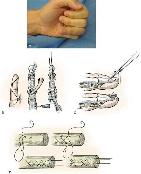 Flexor Tendon Injury Clinical Tree