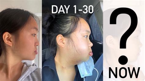 Double Jaw Surgery Timeline Day 1 30 One Video Each Day Before