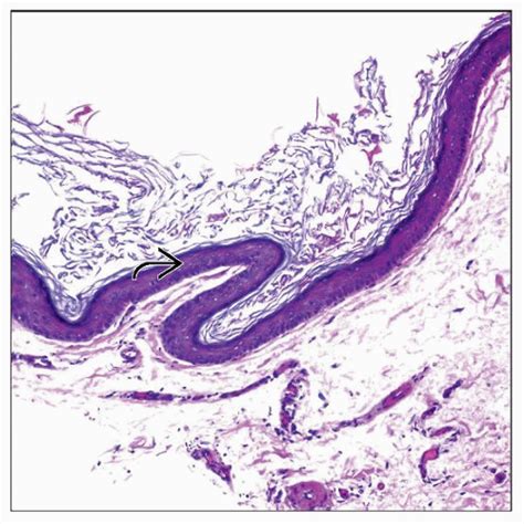 Epidermoid Cyst Histology