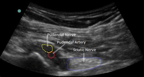 Pudendal Nerve Block Procedure