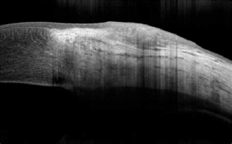 Conjunctival Nevus Seen In The Anterior Segment Optical Coherence Download Scientific Diagram