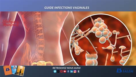 Guide Infections Vaginales