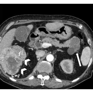 Correlation Of MDCT Imaging Findings With Further Imaging Follow Up