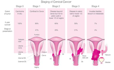 Cervical Cancer Stages