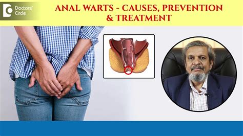 Small Growths On Your Bottom What Are Anal Warts Its Treatment Dr Rajasekhar M R Doctors