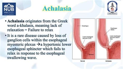 Dysphagia And Achalasia Undergraduate Lecture Ppt