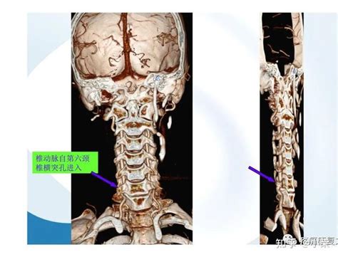 颈椎病查体与诊断 知乎