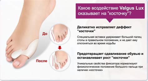 Фиксатор Valgus Pro plus - корректор для большого пальца ноги (гелевая ...