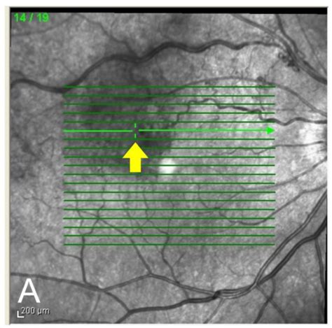 JCM Free Full Text Direct Photocoagulation For Treating