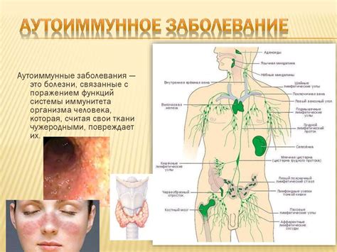Аутоиммунные заболевания - презентация онлайн