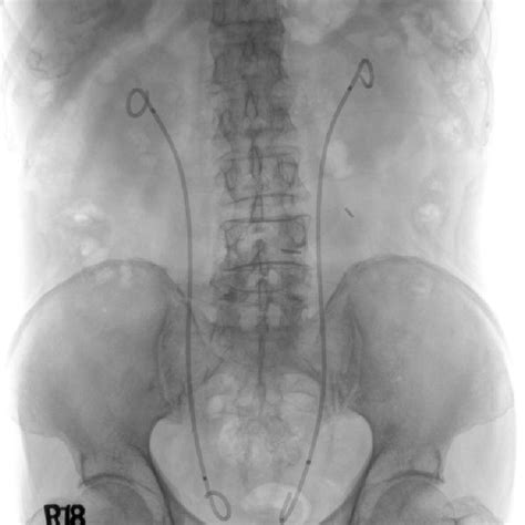 The Ureteral Tumor Stents Bard Angiomed Urosoft In A Plain Film