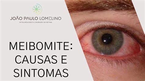 Meibomite Causas E Sintomas Dr Jo O Paulo Lomelino Youtube