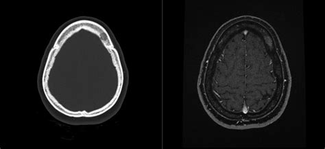 Axial CT and contrast-enhanced MRI imaging of osseous lesion at ...