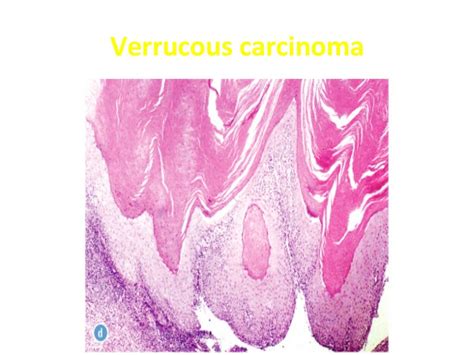 Carcinoma Of Cervix Pathology