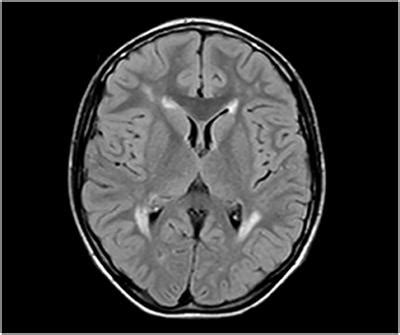 Frontiers Infantile Onset CharcotMarieTooth Disease With Pyramidal