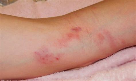 Tengo más riesgo de cáncer si sufro dermatitis atópica Dra LOREA