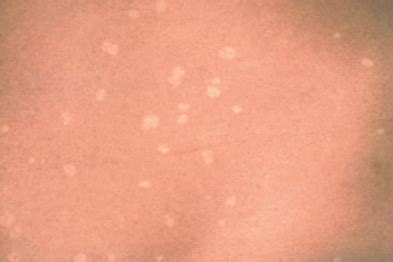 Pictorial Case Study Pityriasis Versicolor GPonline