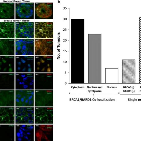 BRCA1 And BARD1 Sub Cellular Colocalization In Breast Cancer Tissues A