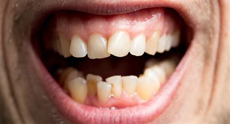 Crooked Teeth Causes And Treatments Smile Works Dental