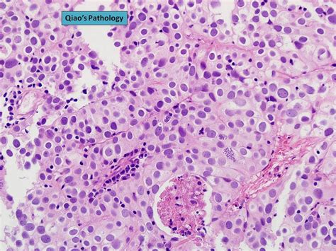 Qiao S Pathology High Grade Papillary Urothelial Carcinoma Of The