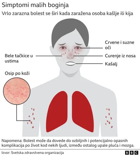 Male boginje Koji su simptomi i kako sprečiti zarazu BBC News na srpskom