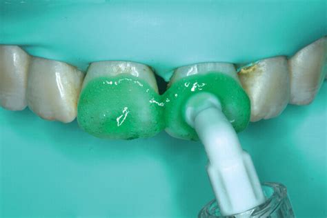 Icon Resin Infiltration - Atlas Dental