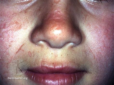 7 Rare Skin Diseases