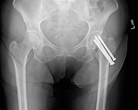 Ortho Dx: Failed Hip Pinning - Clinical Advisor