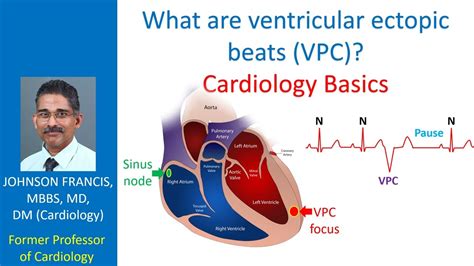 What Are Ventricular Ectopic Beats Vpc Cardiology Basics Youtube