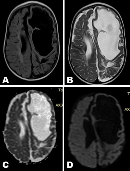 Porencephalic Cyst Mri