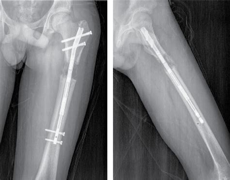 First Case Series Of Femoral Lengthening Using A Precice